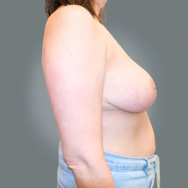 After breast reduction left side view