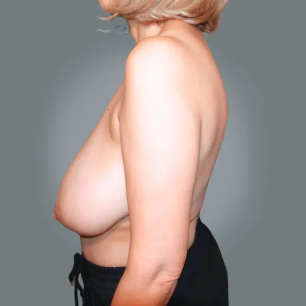 Before breast reduction right side view