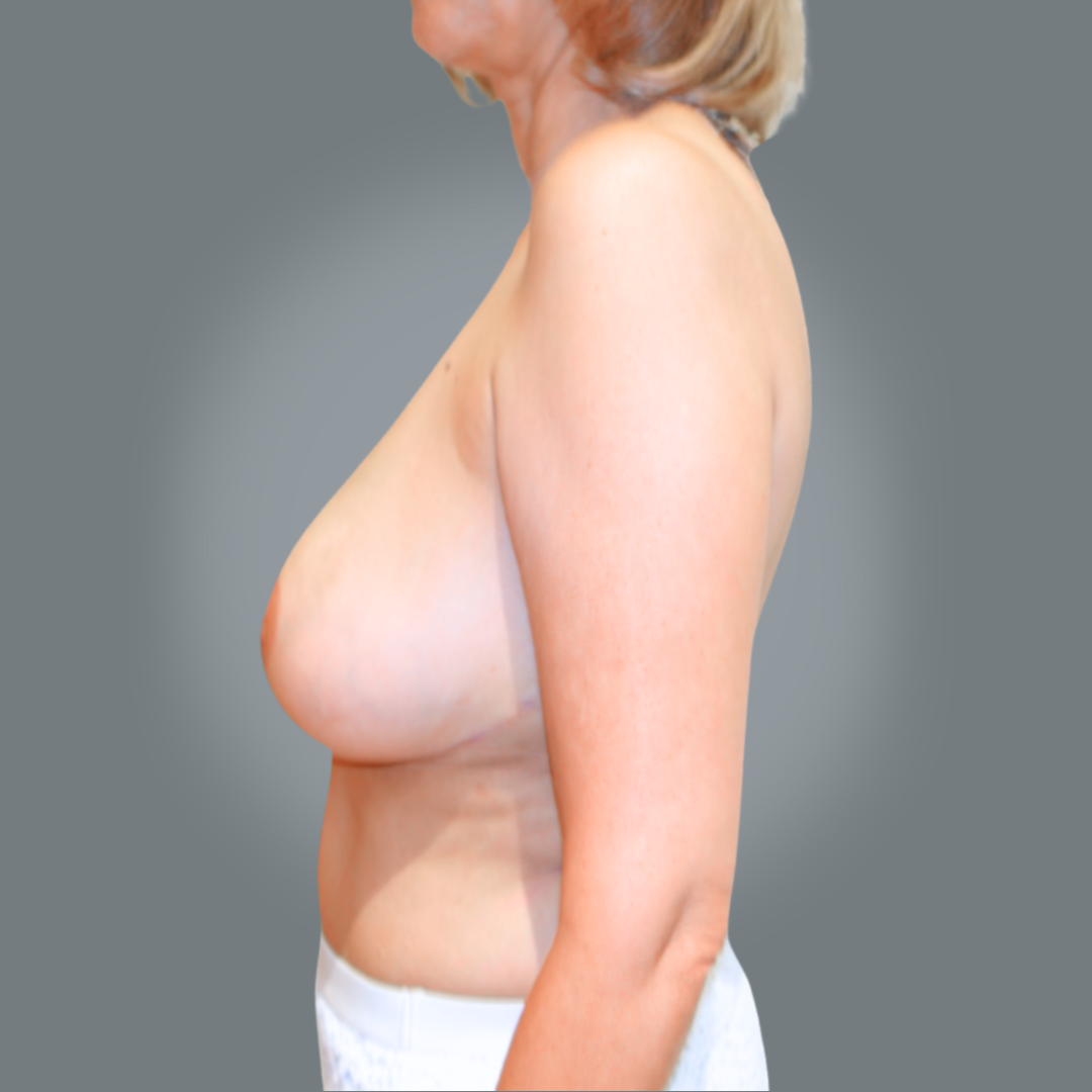 Before breast reduction left side view