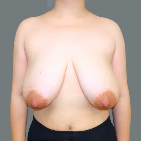 Before breast reduction front view