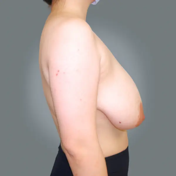 Before breast reduction left side view