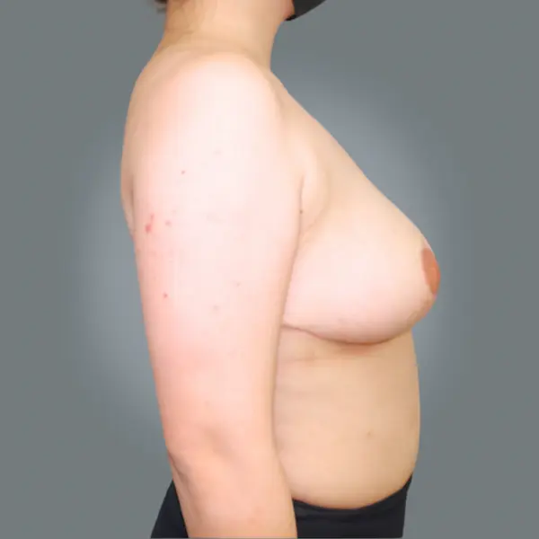 After breast reduction left side view