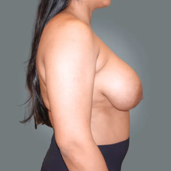 Before breast reduction left side view