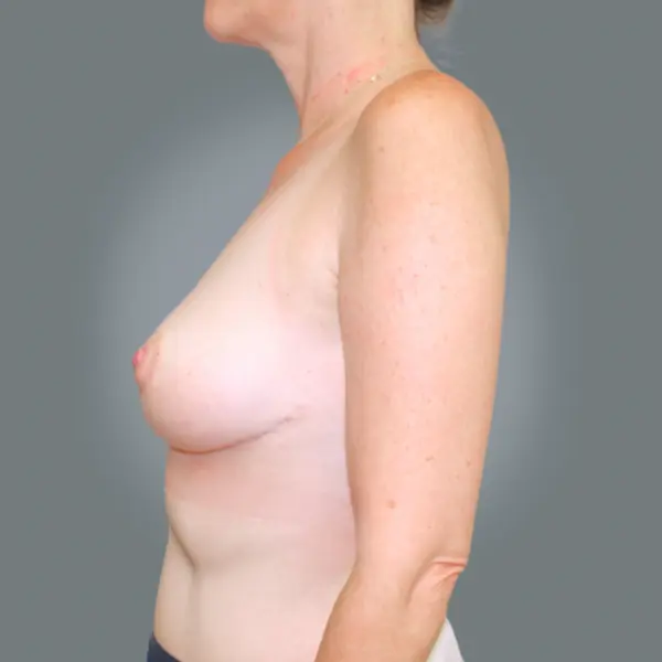 After breast reduction right side view