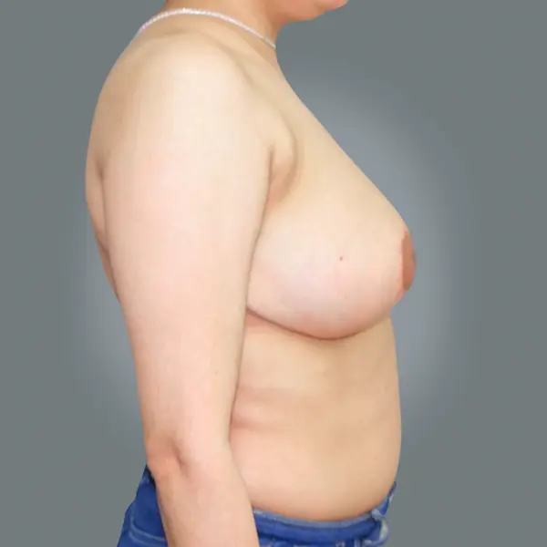 After breast reduction left side view