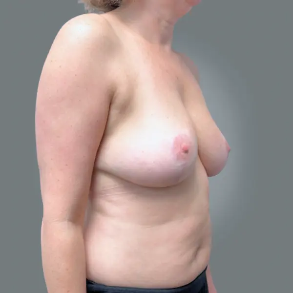 After breast reduction left oblique view