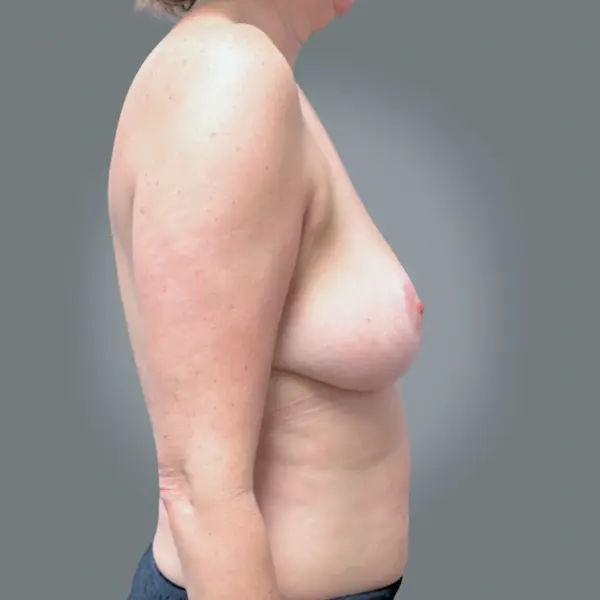 After breast reduction left side view