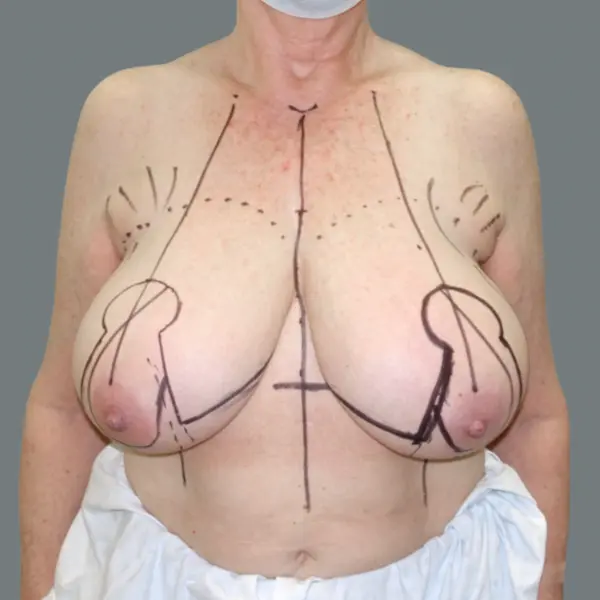 Before breast reduction front view