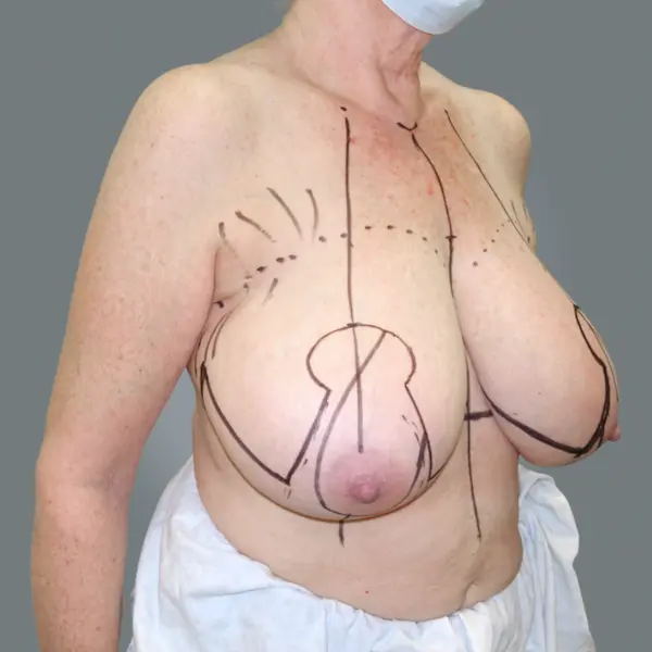 Before breast reduction left oblique view