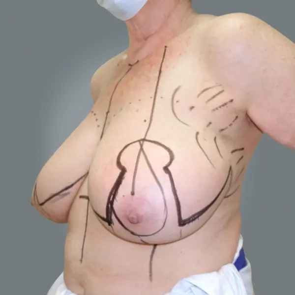 Before breast reduction right side view