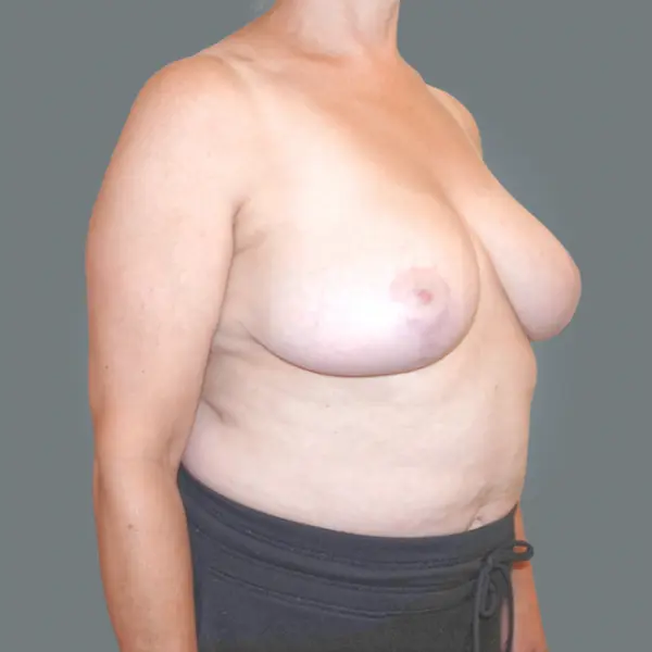 After breast reduction left oblique view