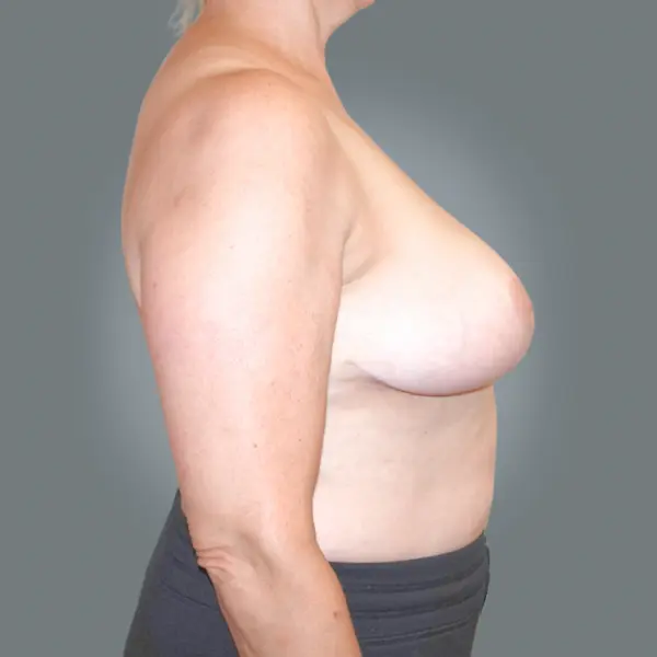 After breast reduction left side view
