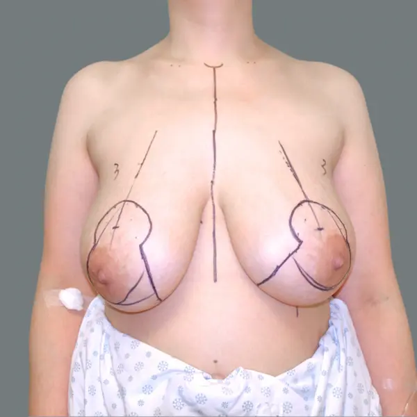 Before breast reduction front view