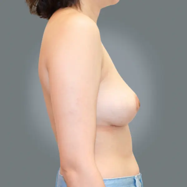After breast reduction left side view