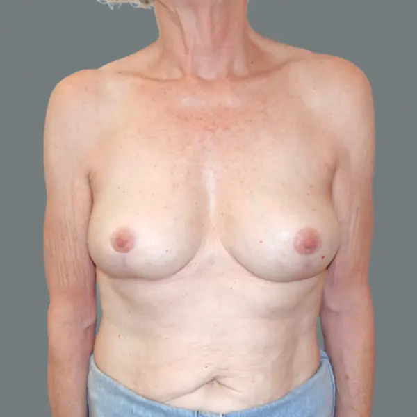 After breast reduction front view