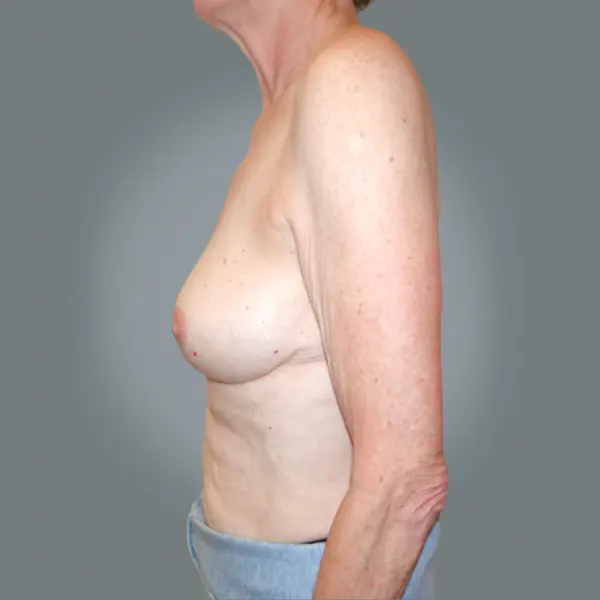 After breast reduction right side view