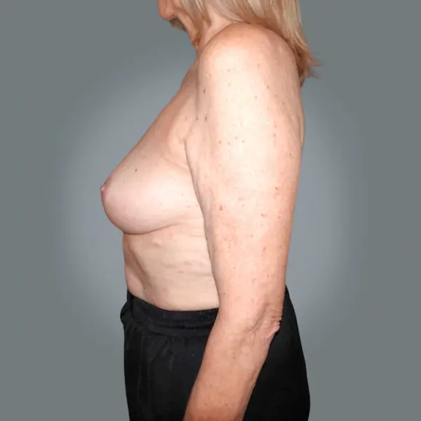 After breast reduction right side view