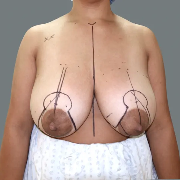 Before breast reduction front view