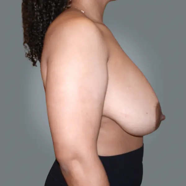 Before breast reduction left side view