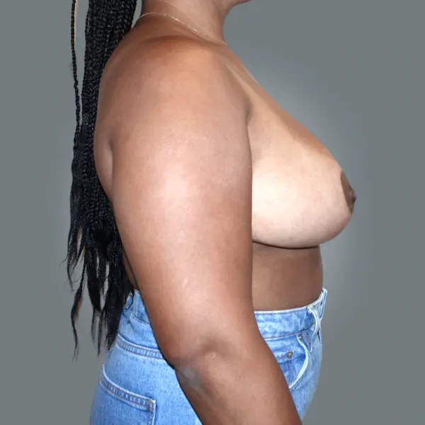 After breast reduction left side view