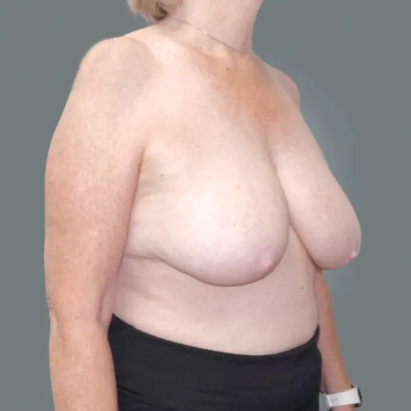Before breast reduction left oblique view