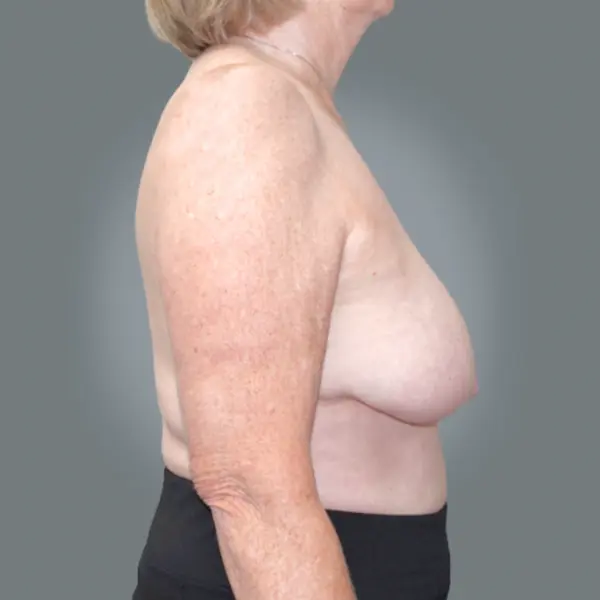 Before breast reduction left side view