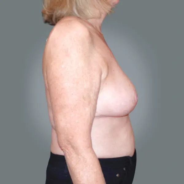 After breast reduction left side view