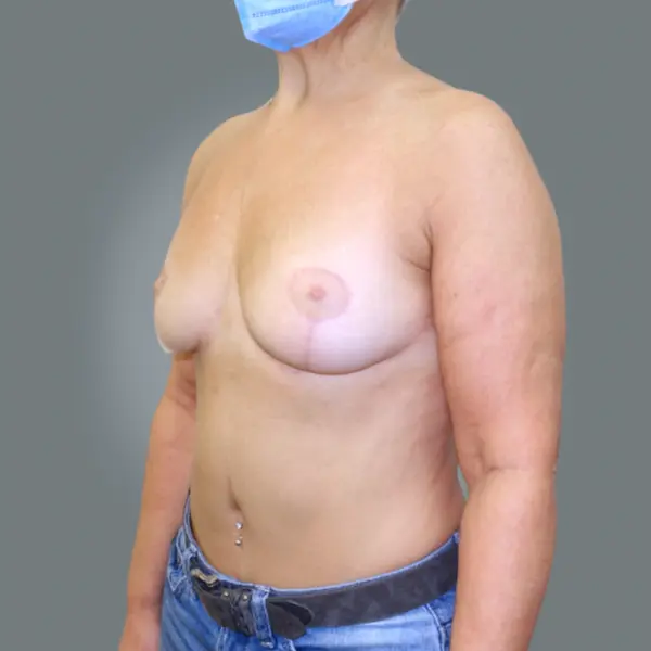 After breast reduction right oblique view