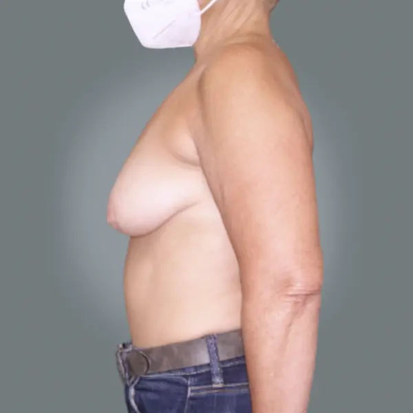 Before breast reduction right side view