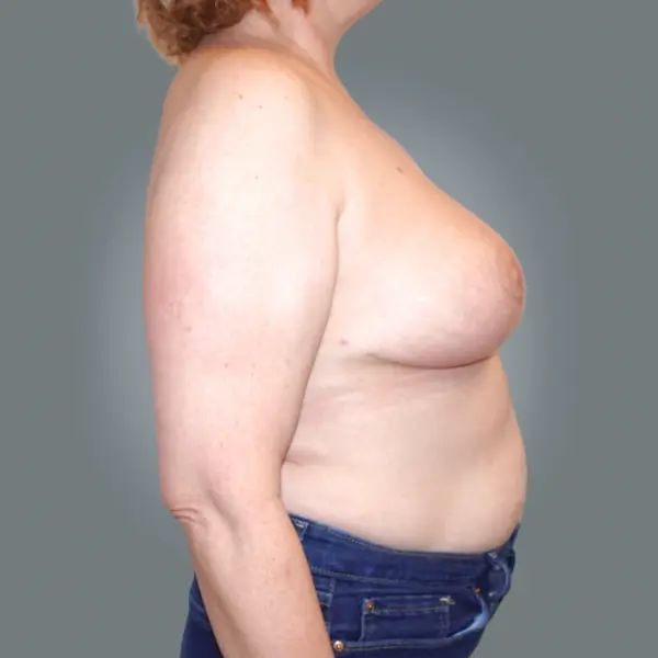 After breast reduction left side view