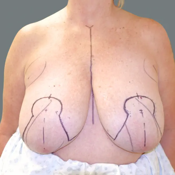 Before breast reduction front view