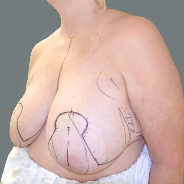 Before breast reduction right oblique view