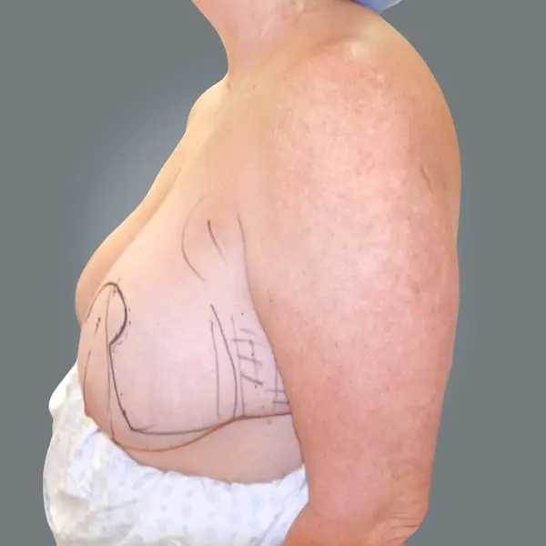 Before breast reduction right side view