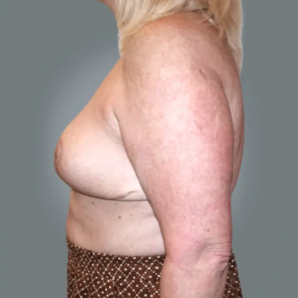 After breast reduction right side view