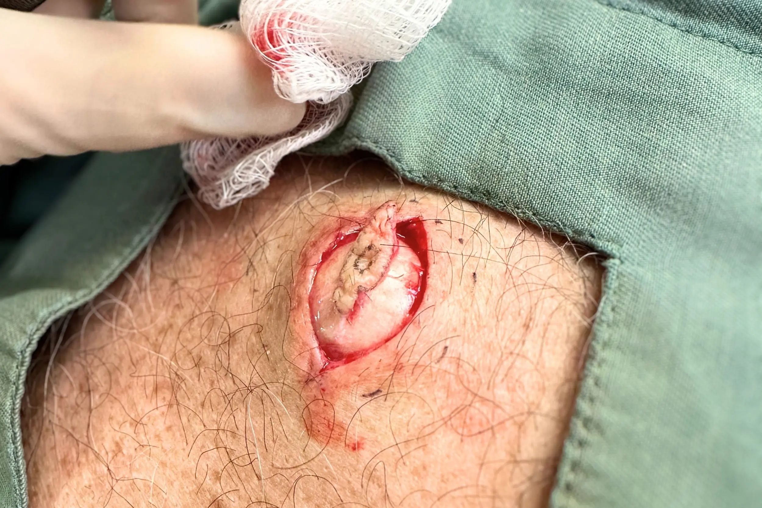 Cyst removal process