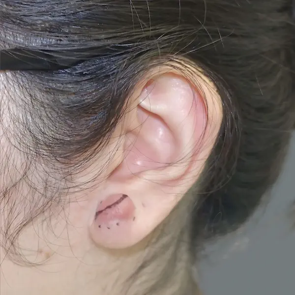 Ear keloid before treatment, side view