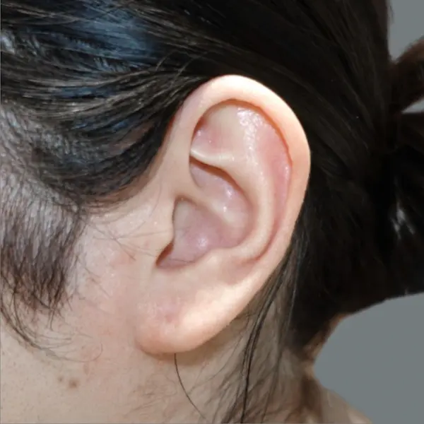 Ear keloid after treatment, side view