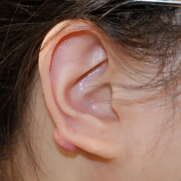 Ear keloid before treatment, side view