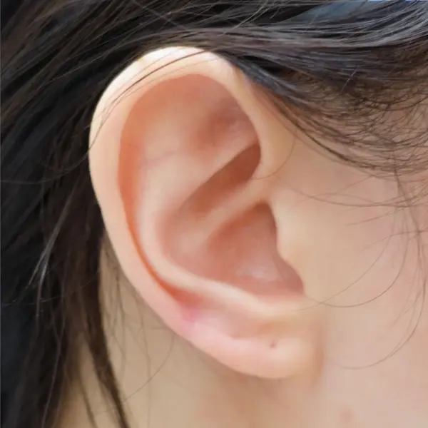 Ear keloid after treatment, side view