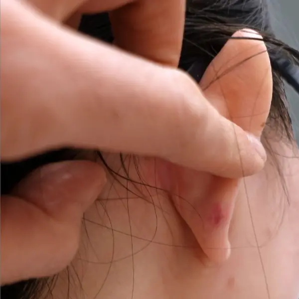 Ear keloid after treatment, back view