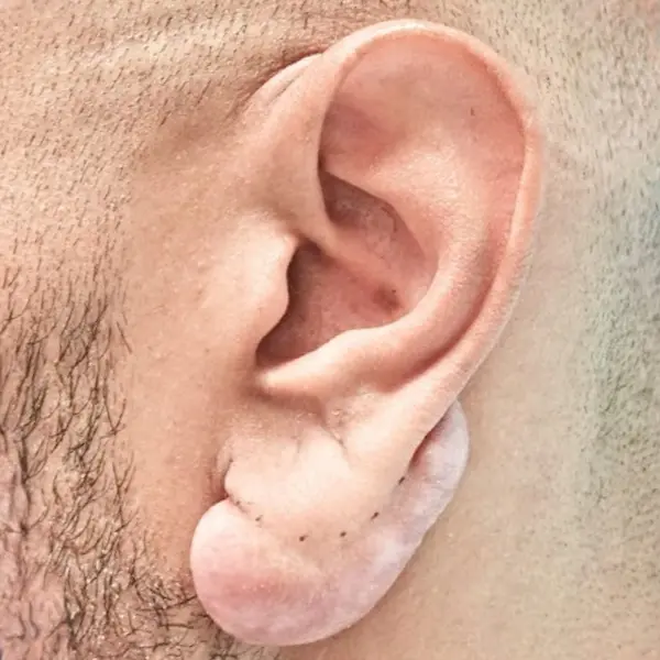 Ear keloid before surgical treatment