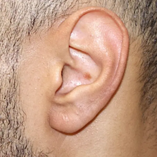 Ear after keloid excision and healing