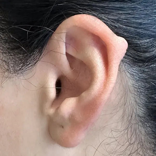 Ear keloid before treatment, side view
