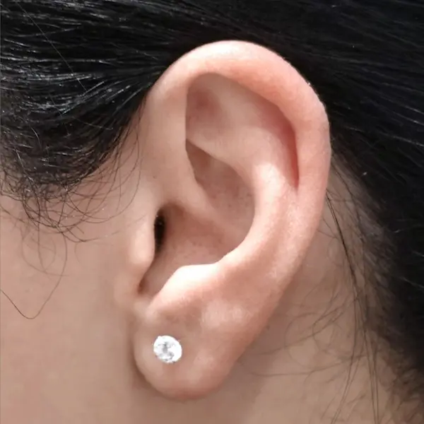 Ear keloid before treatment, side view