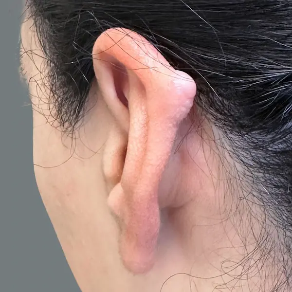 Ear keloid before treatment, back view
