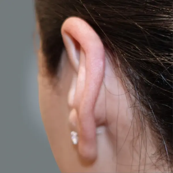 Ear keloid after treatment, back view