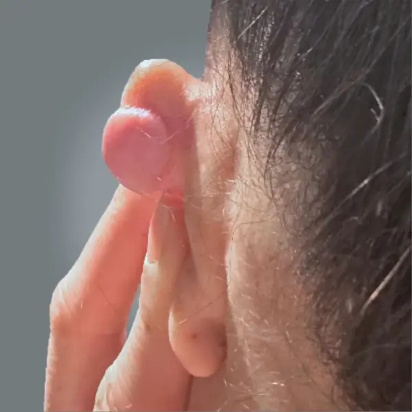 Ear keloid before treatment, back view