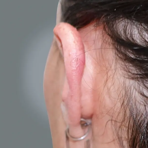 Ear keloid after treatment, back view