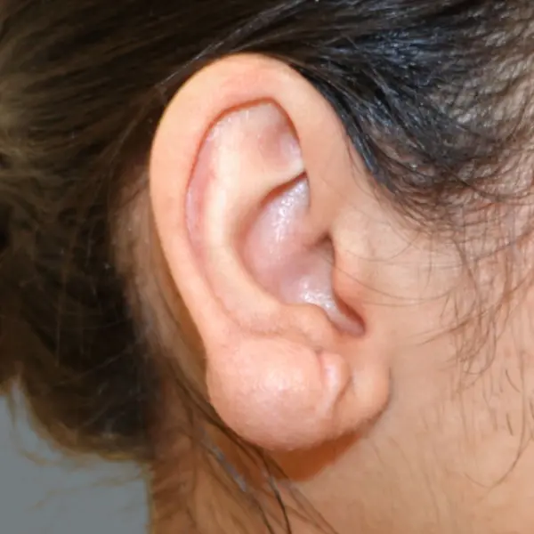 Ear keloid before treatment, side view