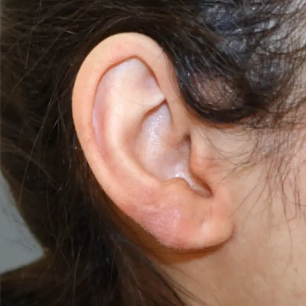 Ear keloid after treatment, side view